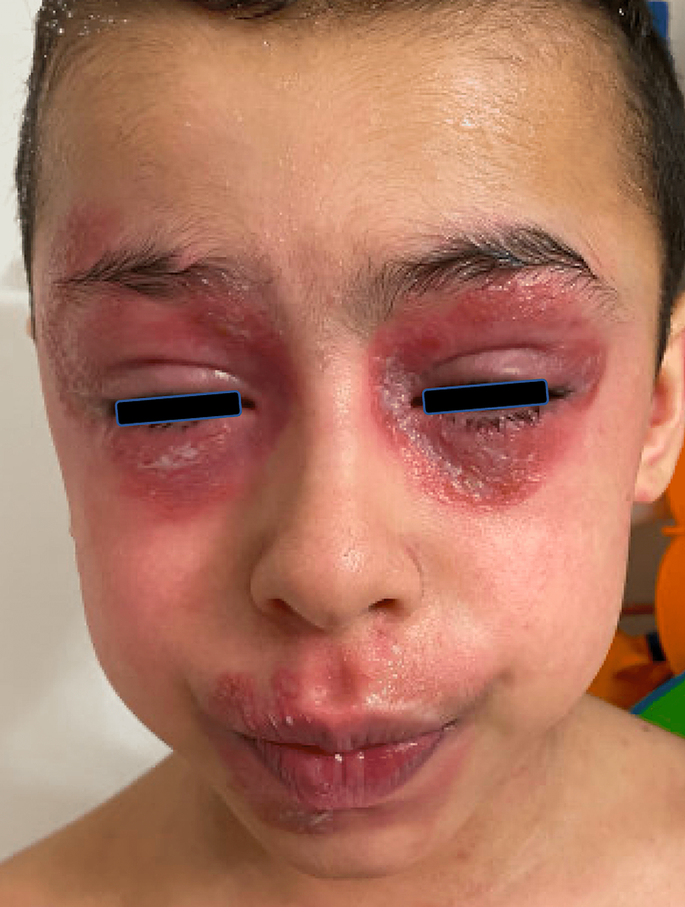 Dupilumab-Associated Head and Neck Dermatitis With Ocular Involvement in a Ten-Year-Old With Atopic Dermatitis: A Case Report and Review of the Literature