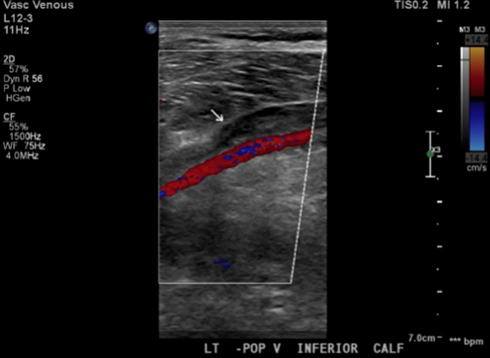 Moderna COVID-19 Vaccine: A New Player in Vaccine-Induced Thrombosis Without Thrombocytopenia