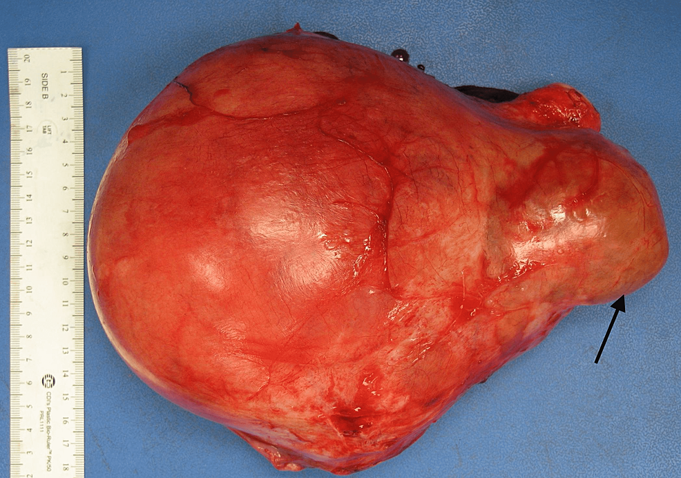 Cotyledonoid Dissecting Leiomyoma: A Rare Variant of Leiomyoma of the Uterus