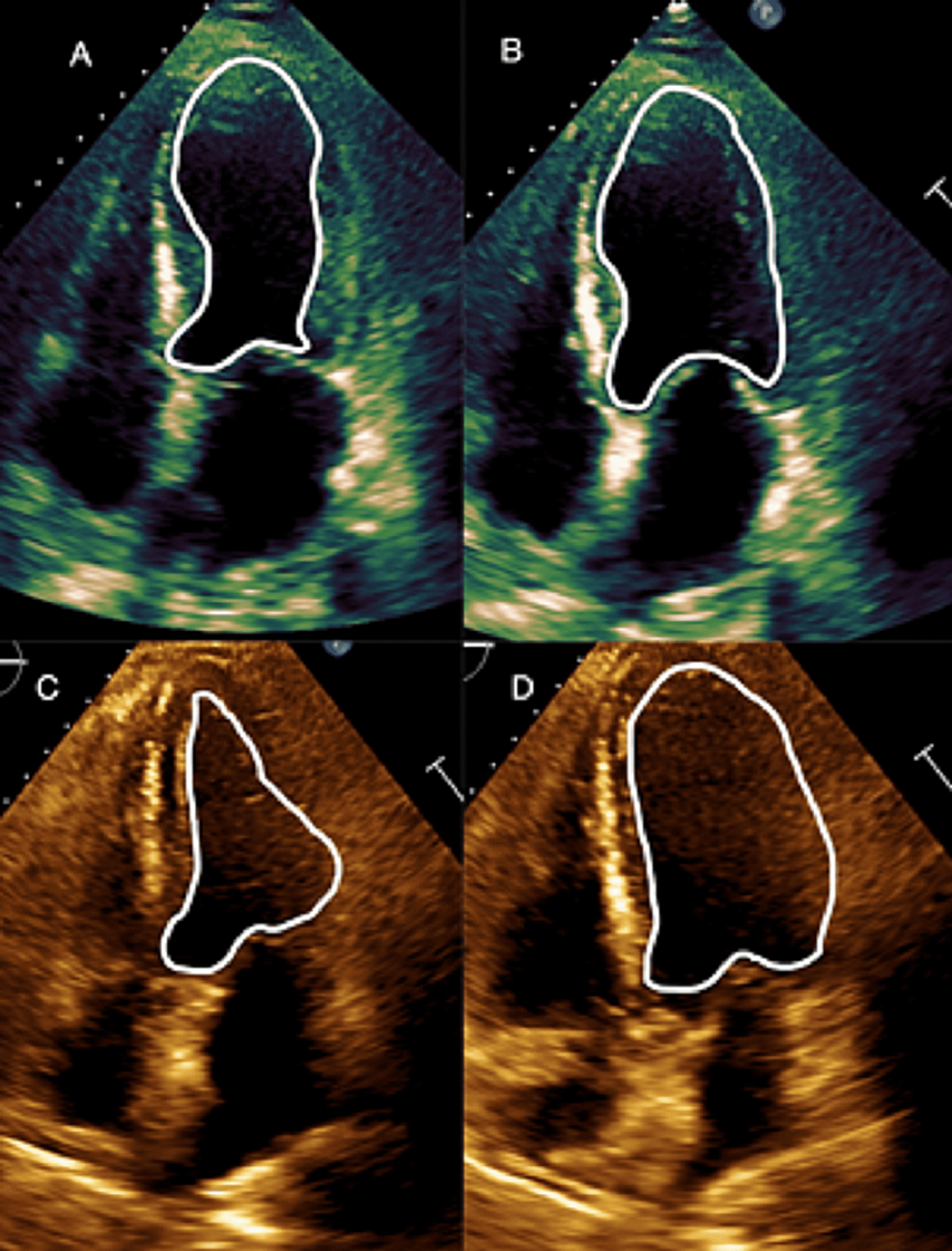 A Case Report and 31-Case Study: Does Takotsubo Cardiomyopathy in Myasthenia Gravis Patients Have a High Mortality Rate?