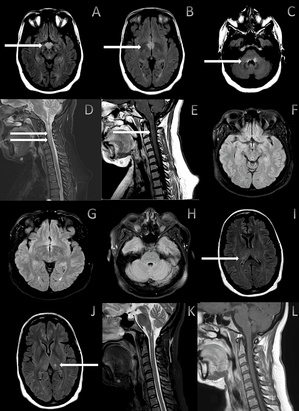 Overlapping Autoimmune Neurological Syndrome: A Case Report of Triple-Positive Antibody