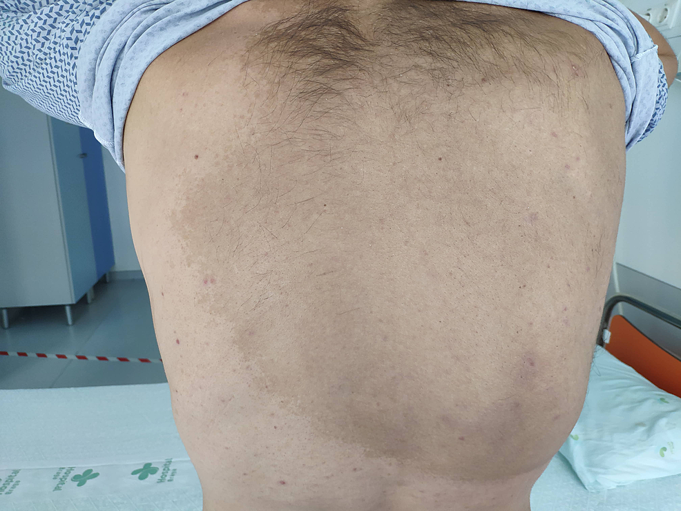 Primary Progressive Multiple Sclerosis in a Portuguese Patient With Neurofibromatosis Type 1