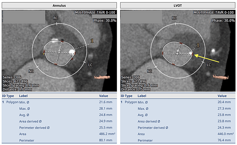 Annular Rupture Due to Calcified Nodule Located in Left Ventricular Outflow Tract (LVOT) During Transcatheter Aortic Valve Replacement (TAVR) Managed by Protamine Sulfate