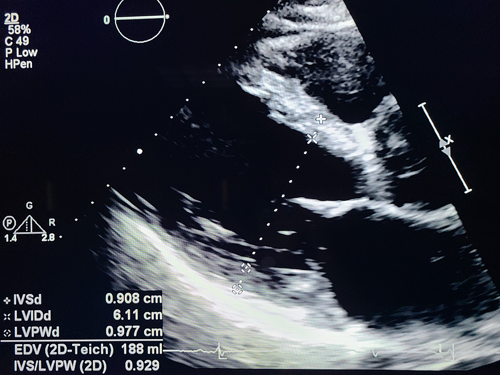 An Atypical Presentation of Severe Dissecting Aortic Aneurysm: A Case Report and Literature Review