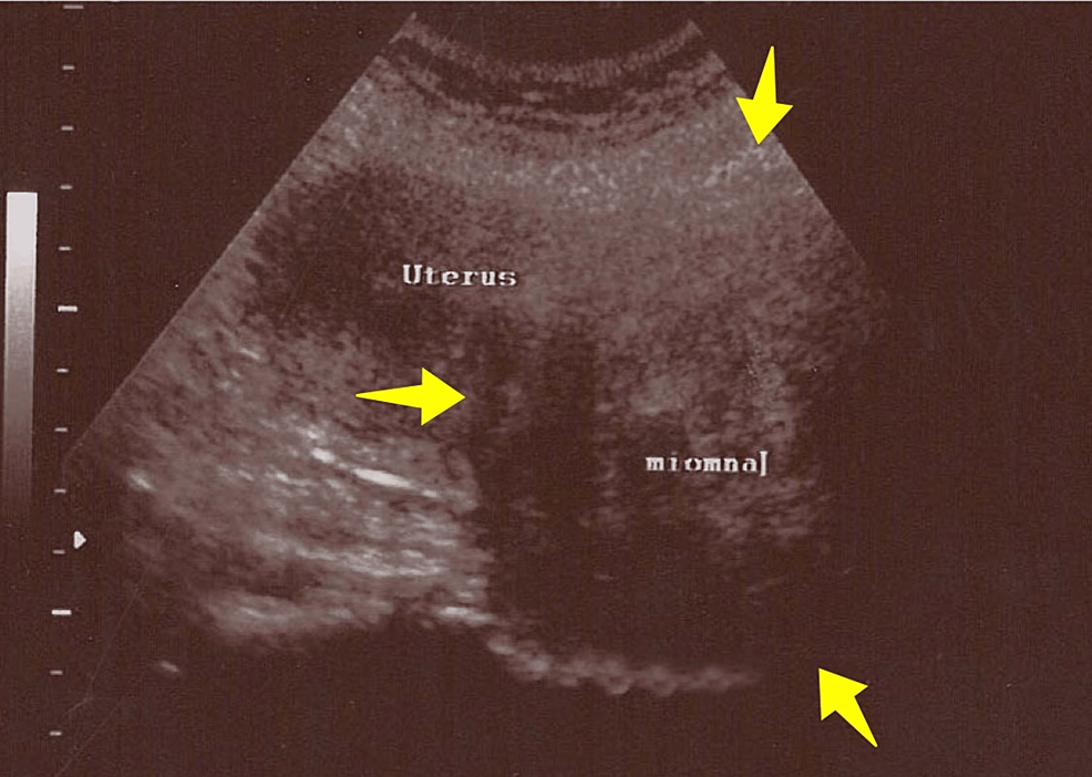 Large Cervical Leiomyoma of the Uterus: A Rare Cause of Chronic Pelvic Pain Associated With Obstructive Uropathy and Renal Dysfunction: A Case Report