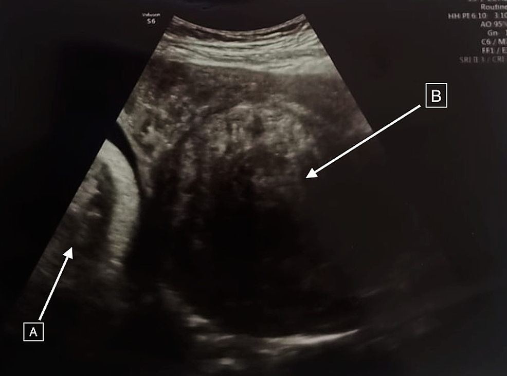 Are Deliveries by Inverted T-Incision on the Rise Due to Fibroids?: A Case Report