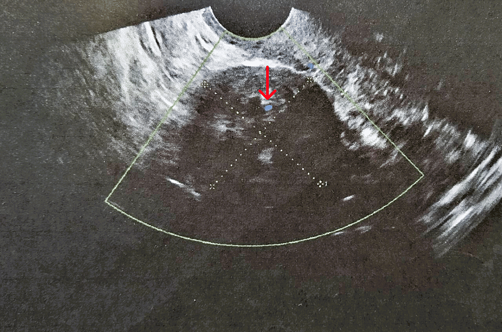 Surgical Treatment of a Rare Case of Ovarian Fibroma Associated With Elevated CA125 Levels in a Patient of Reproductive Age: A Case Report