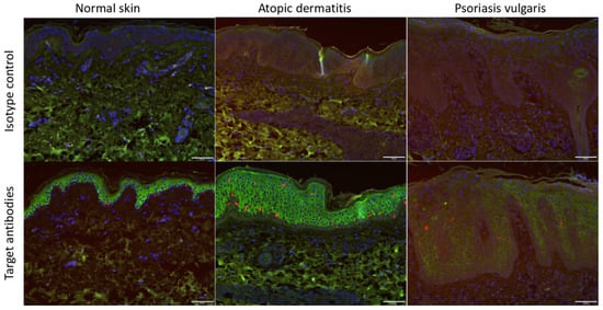 IL-33 Enhances ACE2 Expression on Epidermal Keratinocytes in Atopic Dermatitis: A Plausible Issue for SARS-CoV-2 Transmission in Inflamed Atopic Skin