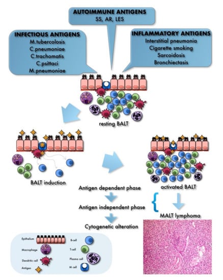 Primary Pulmonary B-Cell Lymphoma: A Review and Update