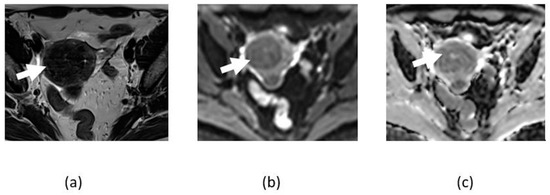 Utility of the Diffusion Weighted Sequence in Gynecological Imaging: Review Article