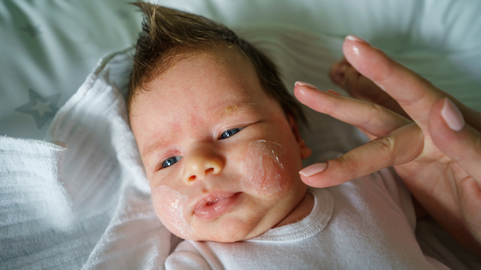 Caregiver Burden in Atopic Dermatitis | National Eczema Association