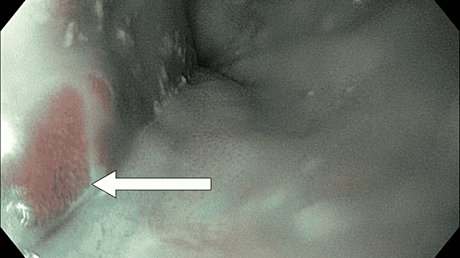 Sensitivity and Specificity of a Novel Colony Characteristic for Determination of Methicillin-Resistant Staphylococcus aureus