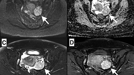 Hyperglycemia in Severe and Critical COVID-19 Patients: Risk Factors and Outcomes