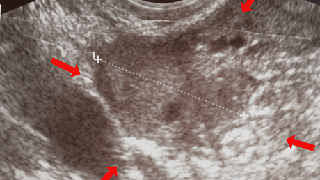 A Review of the Recent Monkeypox Outbreak in 2022
