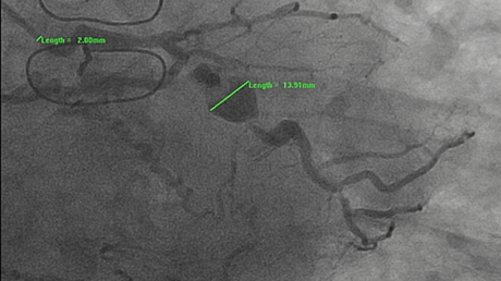 The Efficacy of Bezlotoxumab in the Prevention of Recurrent Clostridium difficile: A Systematic Review