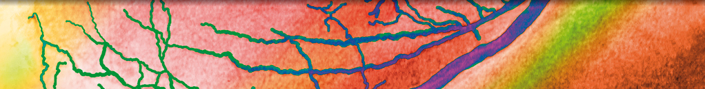 Lactococcus garvieae: An Uncommon Human Pathogen Causing Infective Endocarditis in a Valve-in-Valve Transcatheter Aortic Valve Replacement