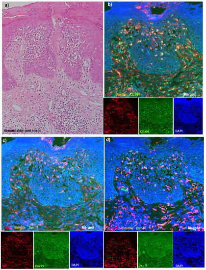 Immunohistopathological Analysis of Immunoglobulin E-Positive Epidermal Dendritic Cells with House Dust Mite Antigens in Naturally Occurring Skin Lesions of Adult and Elderly Patients with Atopic Dermatitis