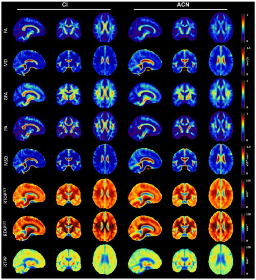 Microstructural MRI Correlates of Cognitive Impairment in Multiple Sclerosis: The Role of Deep Gray Matter