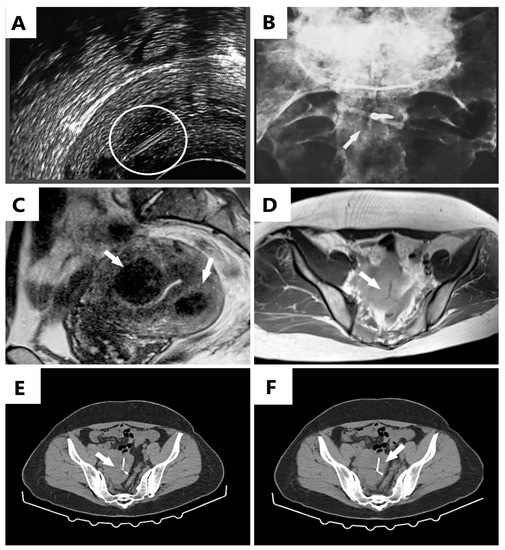An Interesting Image of Transmural Migration of a Levonorgestrel-Releasing Intrauterine Device (LNg-IUD)