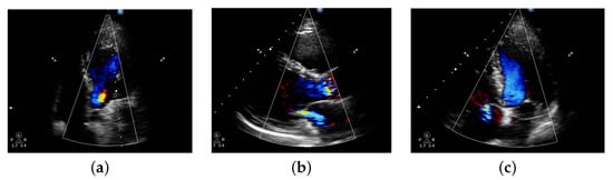Deep Learning Methods for Classification of Certain Abnormalities in Echocardiography