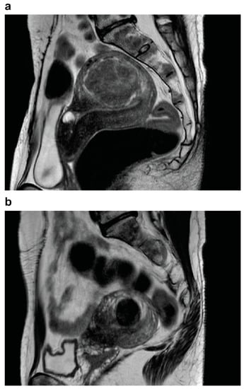 Myoma with Hypermenorrhea Treated with Ultrasound-Guided Microwave Ablation of the Inflowing Blood Vessels to the Uterine Myoma: A Case
