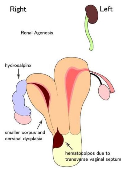 Effects of Hydrosalpinx on Endometrial Receptivity and Uterine Microbiome: An Interesting Case of Double Uterus with Unilateral Hydrosalpinx