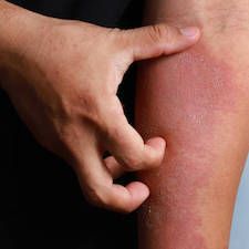 Domestic Hard Water Linked to Increased Eczema Prevalence in UK Adults