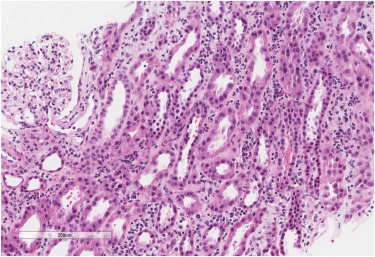 Semaglutide-Associated Acute Interstitial Nephritis: A Case Report