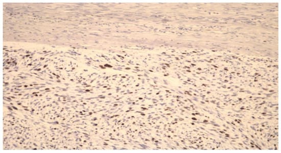 Fibroid Removal after Myomectomy: An Overview on the Problems of Power Morcellation