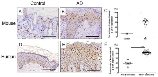 Role of ERK Pathway in the Pathogenesis of Atopic Dermatitis and Its Potential as a Therapeutic Target