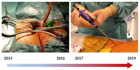 Comparison between Surgical Access and Percutaneous Closure Device in 787 Patients Undergoing Transcatheter Aortic Valve Replacement