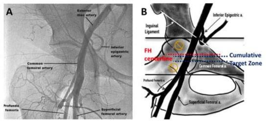 Vascular Complications in TAVR: Incidence, Clinical Impact, and Management