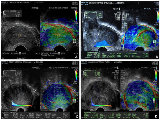In Search of an Imaging Classification of Adenomyosis: A Role for Elastography?