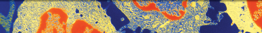 Characterization of Artificial Pneumothorax-Unrelated Pyothorax-Associated Lymphoma