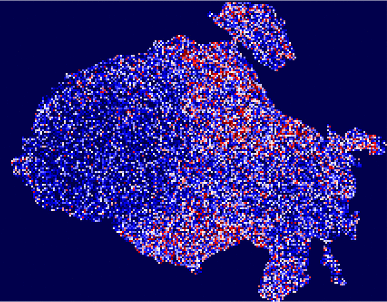 Lung cancer scRNA-seq and lipidomics reveal aberrant lipid metabolism for early-stage diagnosis