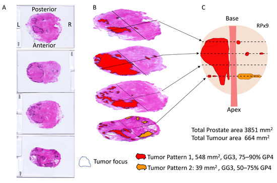 The Urine Biomarker PUR-4 Is Positively Associated with the Amount of Gleason 4 in Human Prostate Cancers