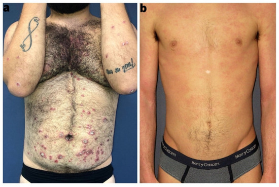 The Impact of Psoriasis and Atopic Dermatitis on Quality of Life: A Literature Research on Biomarkers