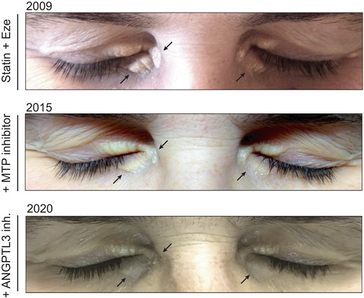 Atherosclerotic plaque regression in homozygous familial hypercholesterolaemia: a case report of a long-term lipid-lowering therapy involving LDL-receptor-independent mechanisms