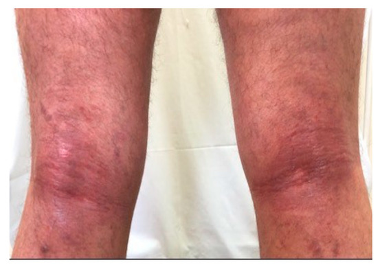 The Effect of SARS-CoV-2 Virus Infection on the Course of Atopic Dermatitis in Patients