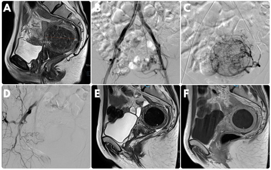 Unilateral Uterine Artery Embolization as a Treatment for Patients with Symptomatic Fibroids-Experience in a Case Series