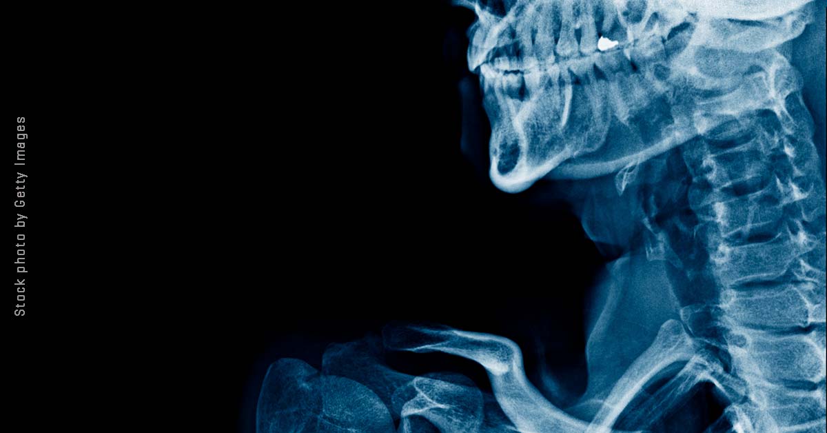 Risk vs. benefit: Bisphosphonates in breast cancer