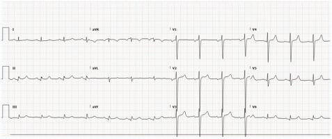 A Rare Case of Radiation-Associated Aortic and Mitral Valve Stenosis Treated With Transcatheter Valve Replacements