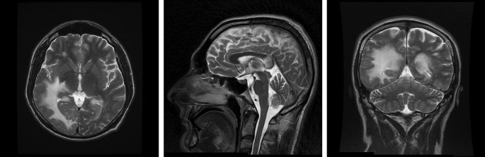 Rapid-progressing progressive multifocal leukoencephalopathy in two patients newly diagnosed with HIV: case series and review of literature - Journal of NeuroVirology