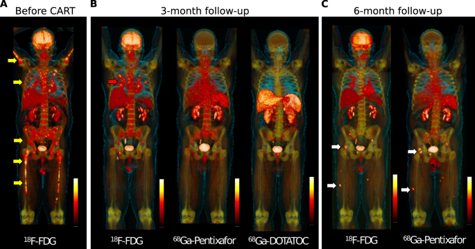 Th17.1 cell driven sarcoidosis-like inflammation after anti-BCMA CAR T cells in multiple myeloma - Leukemia