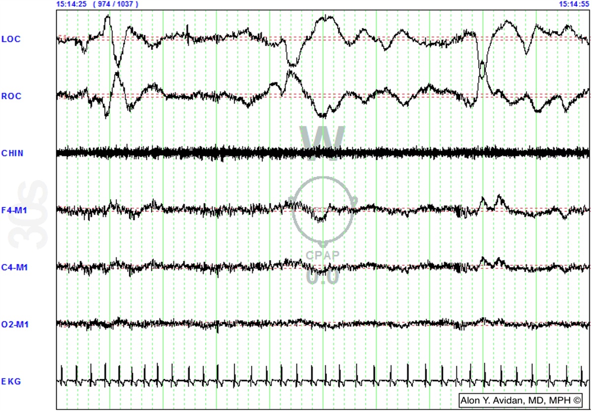 Multiple Sleep Latency Test/Maintenance of Wakefulness Test and Central Hypersomnias: Evolving Diagnostic and Therapeutic Approaches