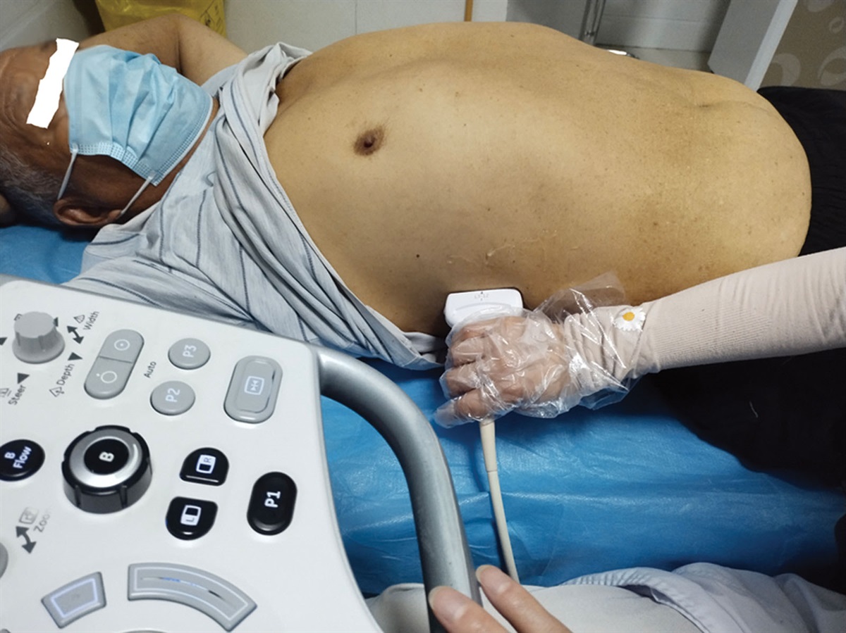Shear wave elastography of the diaphragm in acute exacerbation of chronic obstructive pulmonary disease: A prospective observational study