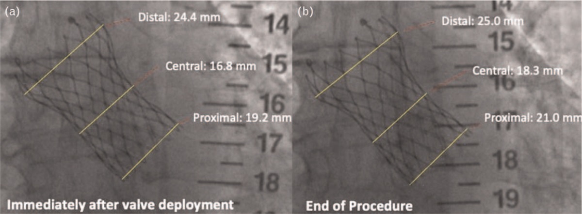 Acute expansion of nitinol-based self-expandable device in patients undergoing transfemoral aortic valve implantation