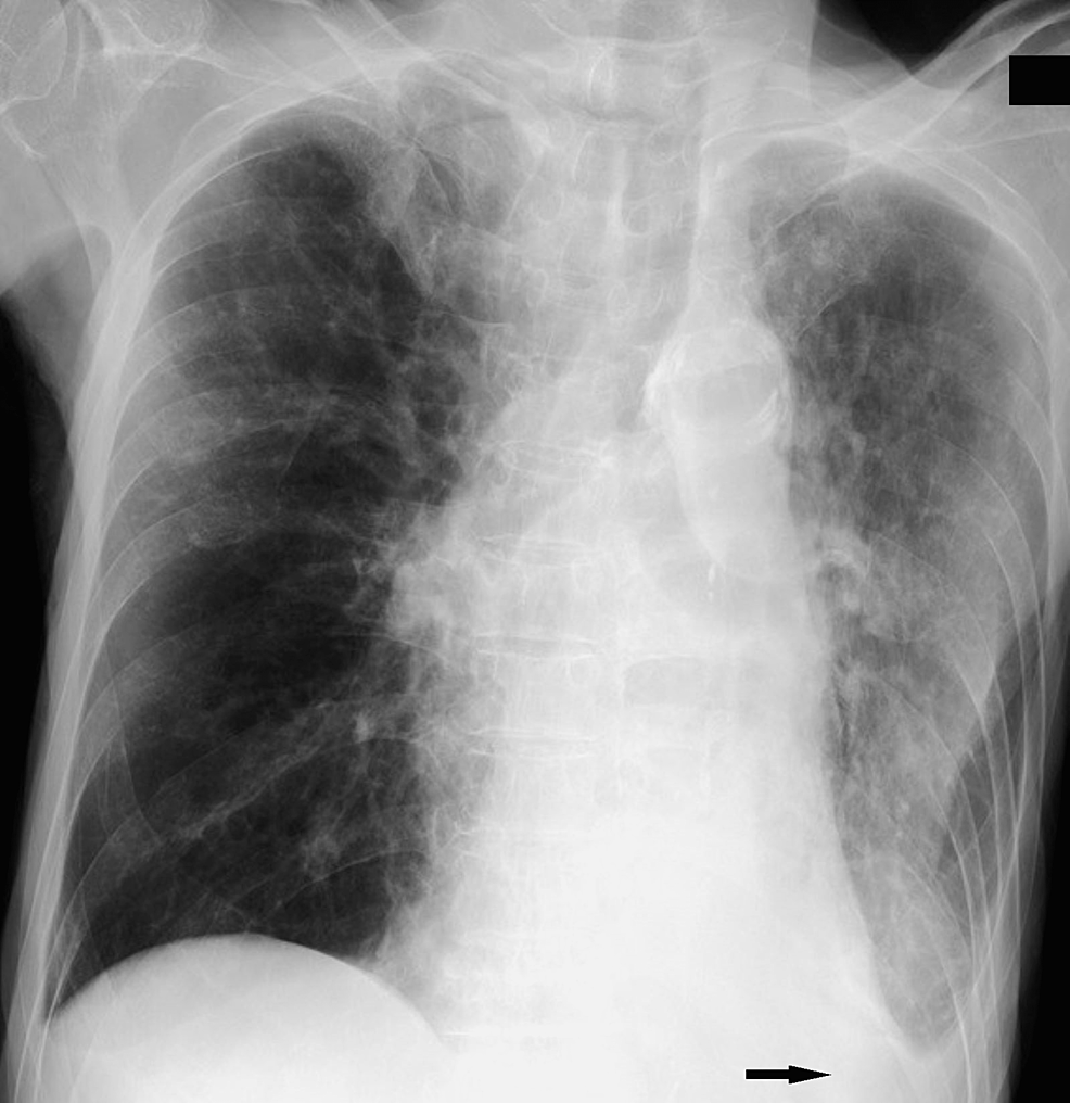 Empyema Caused by Pasteurella multocida in a Patient With Chronic Obstructive Respiratory Disease Taking Inhaled Corticosteroids: A Case Report