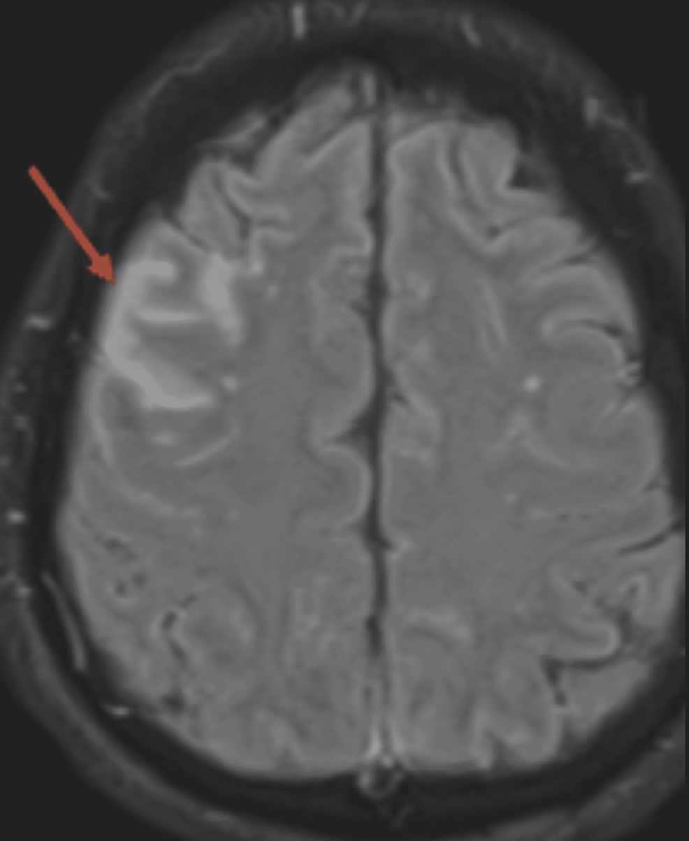 A Sharp Rise in Autoimmune Encephalitis in the COVID-19 Era: A Case Series