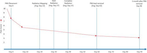 Peripheral Nerve Stimulation for Back Pain in Patients With Multiple Myeloma as Bridge Therapy to Radiation Treatment: A Case Series